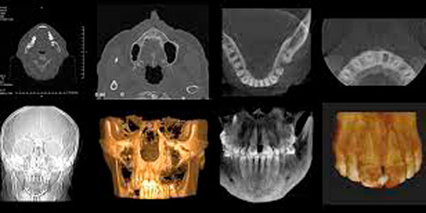 CBCT-para-Endodoncias