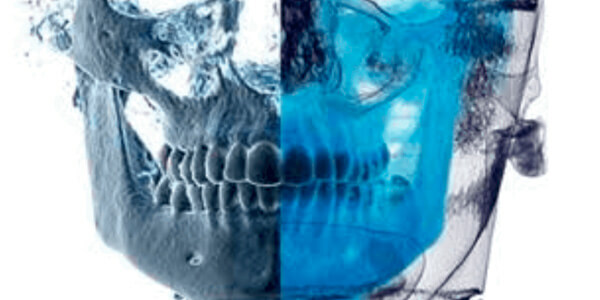 Planeación-Virtual-con-Implantes-Dentales